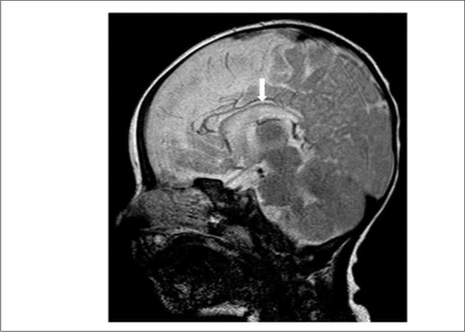 Journal of Preventive Medicine And Care-Shapiro’s syndrome