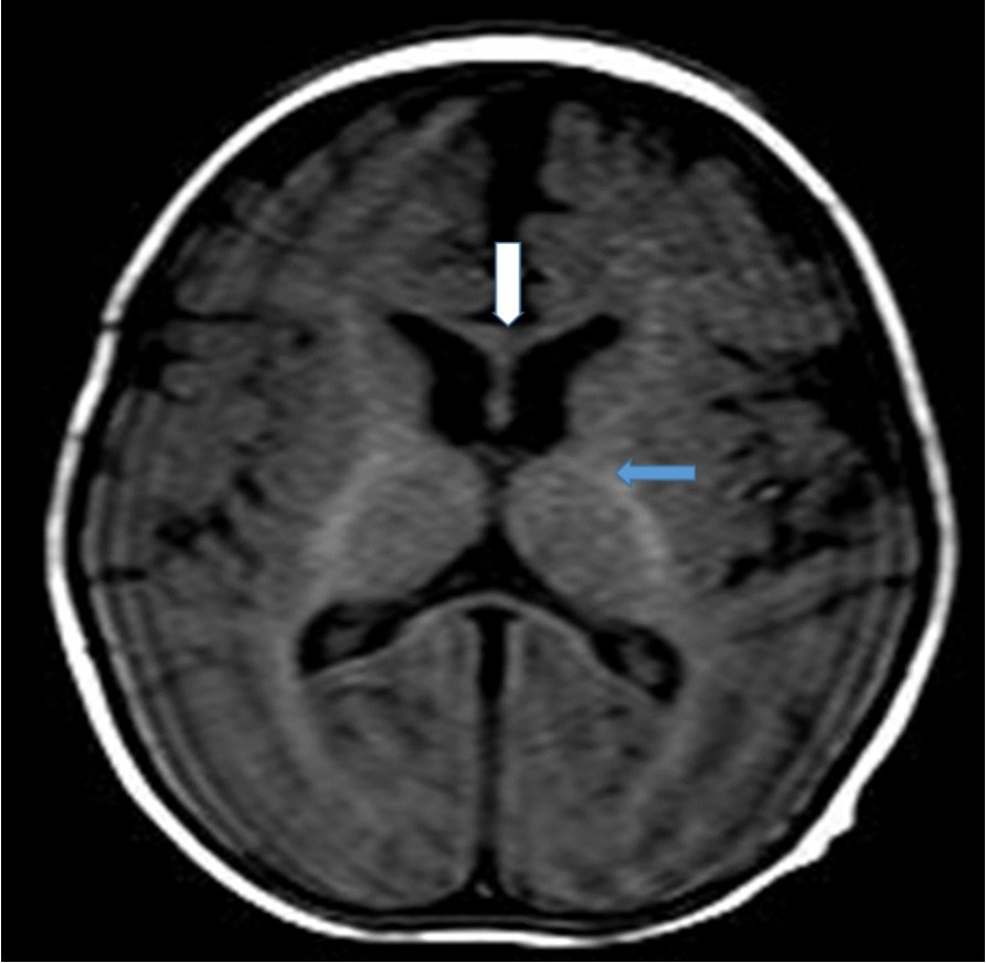 Journal of Preventive Medicine And Care-Shapiro’s syndrome