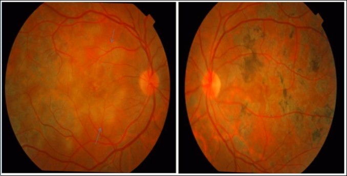 Journal of Ophthalmic Science-Serpiginous multifocal choroiditis