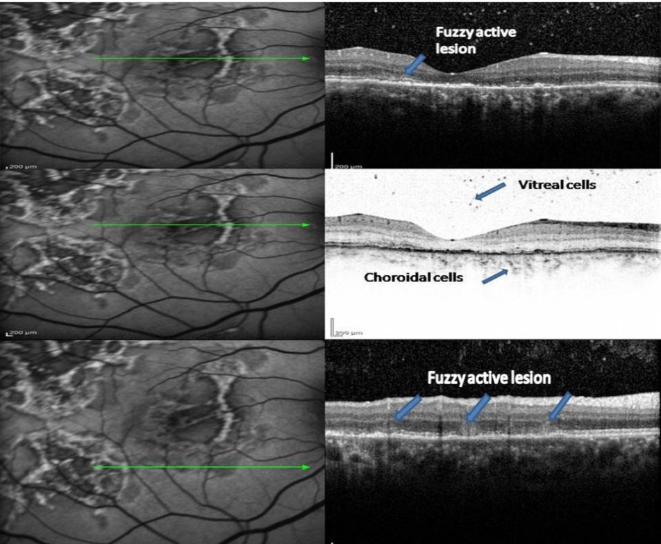 Journal of Ophthalmic Science-Serpiginous multifocal choroiditis