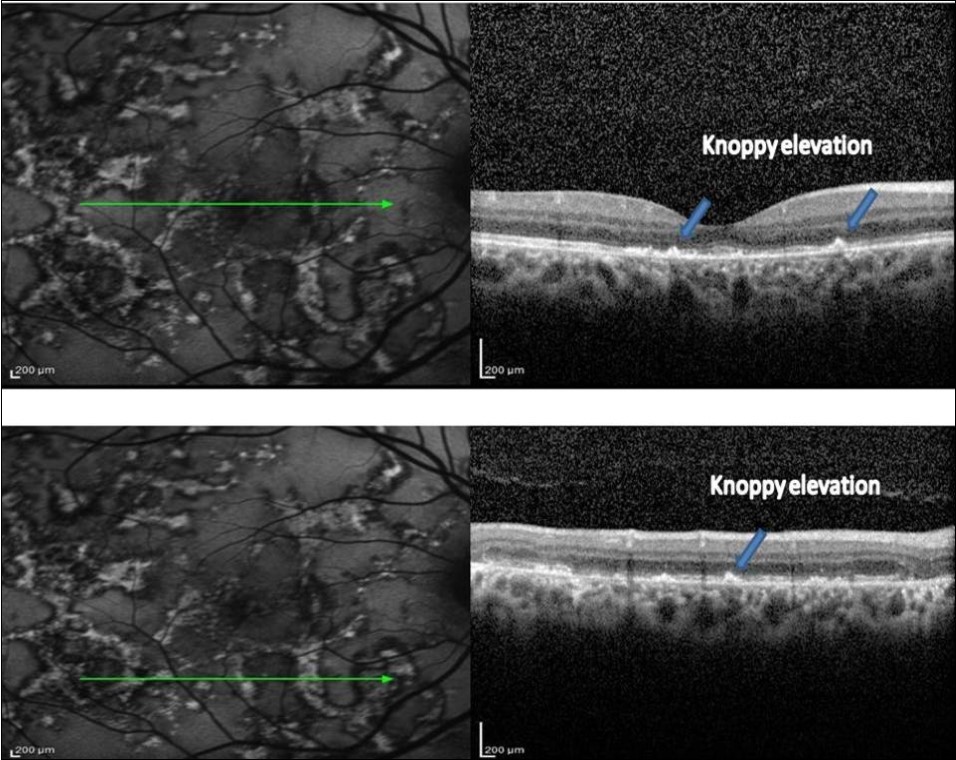 Journal of Ophthalmic Science-Serpiginous multifocal choroiditis