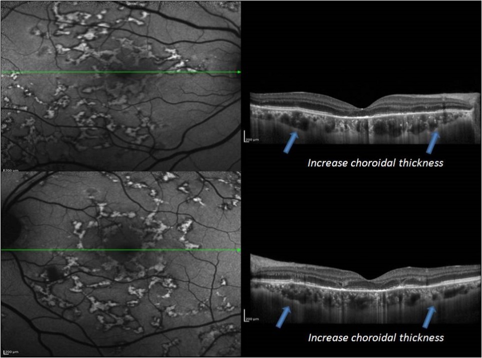 Journal of Ophthalmic Science-Serpiginous multifocal choroiditis