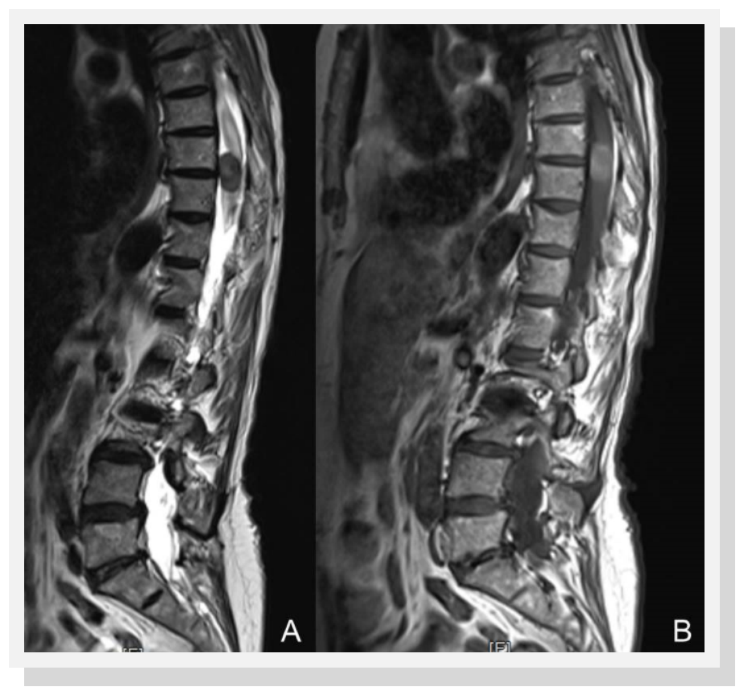 Journal of Brain And Spinal Cancer-melanocytoma
