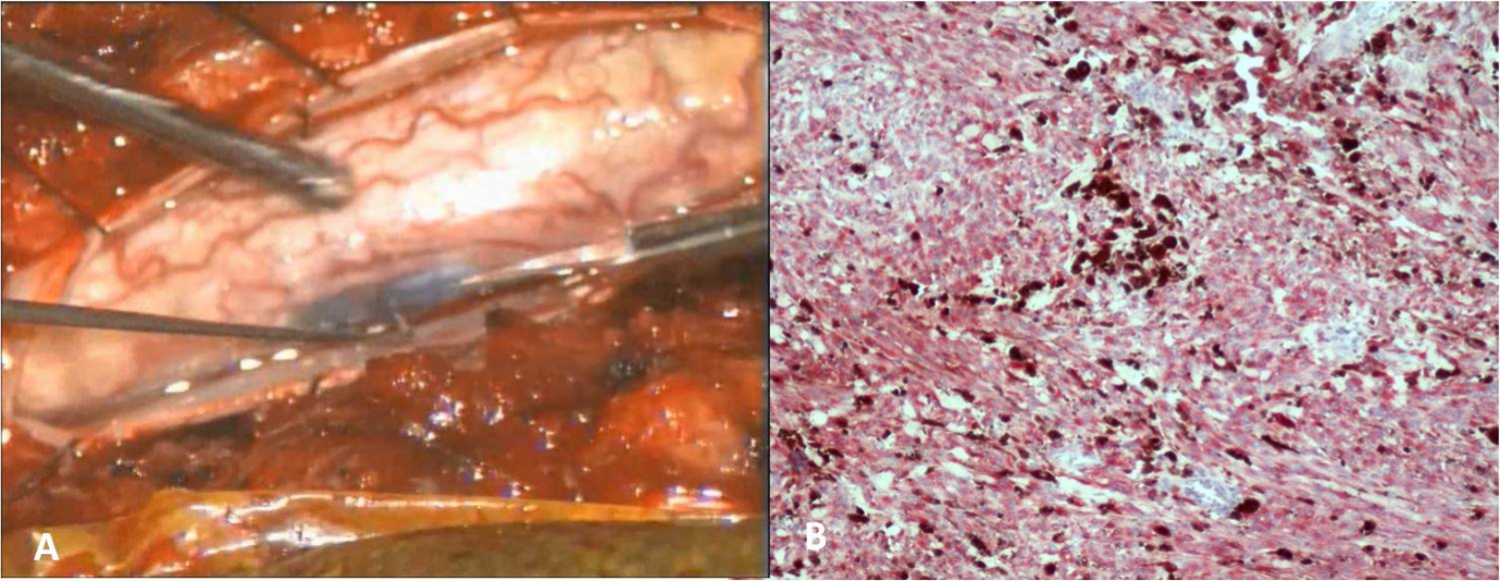 Journal of Brain And Spinal Cancer-melanocytoma