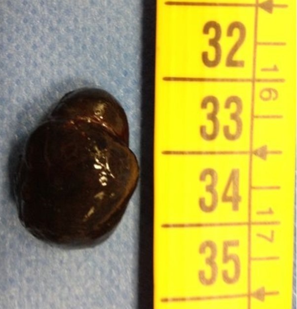Journal of Brain And Spinal Cancer-melanocytoma