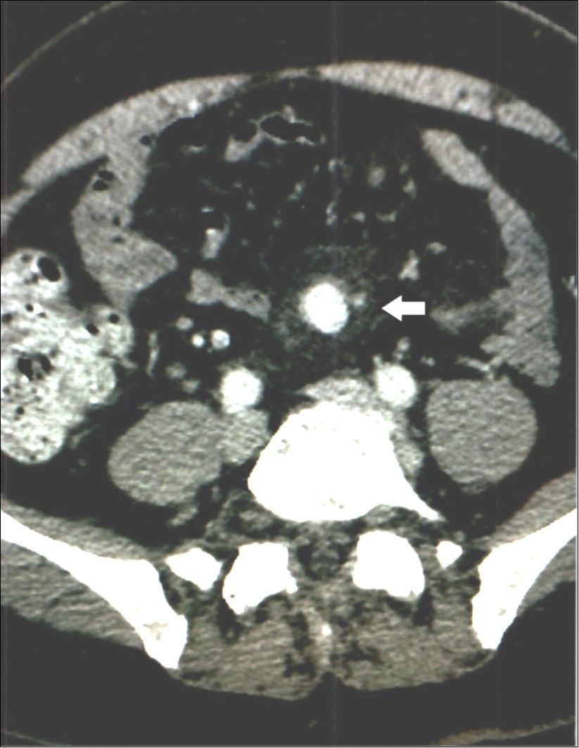 Case 3 – Superior Mesenteric Artery Branch Aneurysm surrounded by a halo.