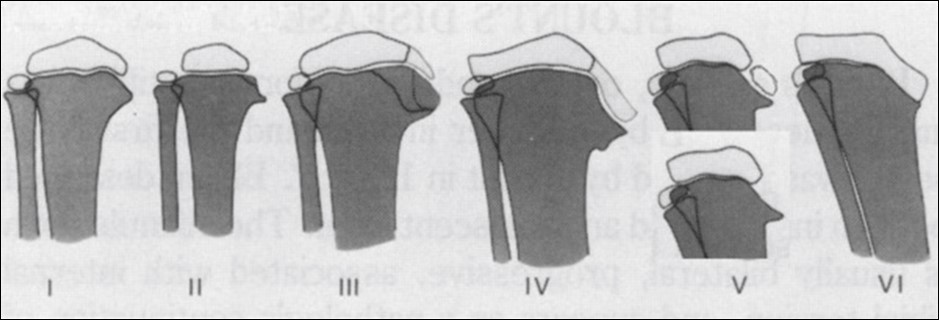 Journal of Preventive Medicine And Care-Infantile Blount’s Disease