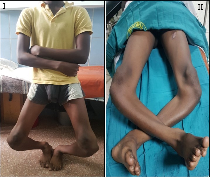 Journal of Preventive Medicine And Care-Infantile Blount’s Disease
