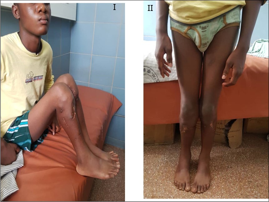 Journal of Preventive Medicine And Care-Infantile Blount’s Disease