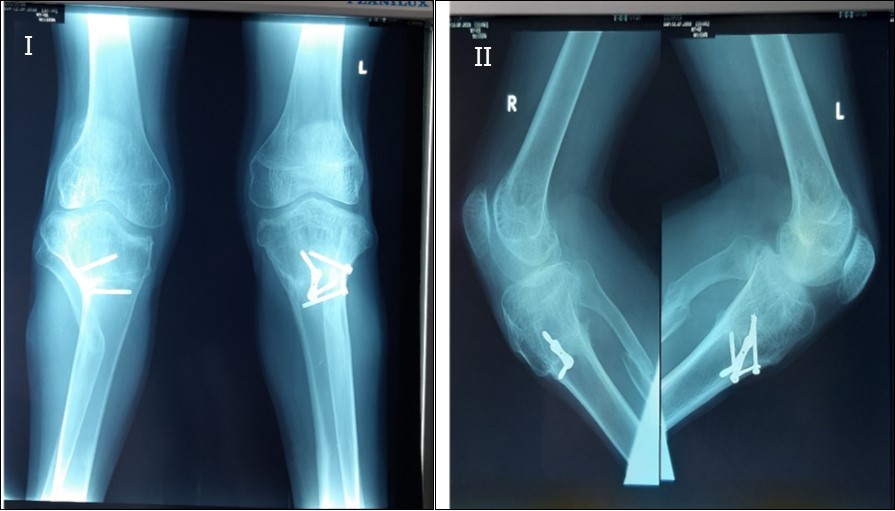 Journal of Preventive Medicine And Care-Infantile Blount’s Disease