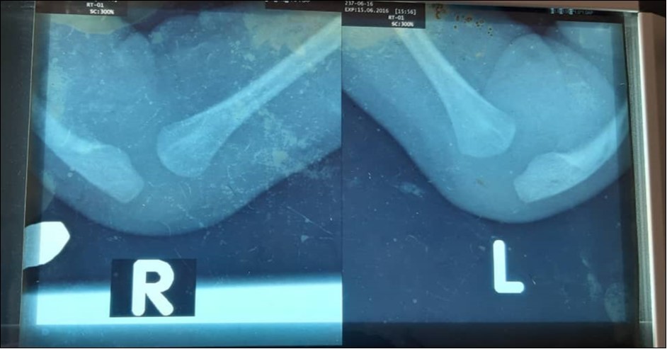Depicts pre-operative radiographs of the forearms of the infant showing bilateral absence of the radius