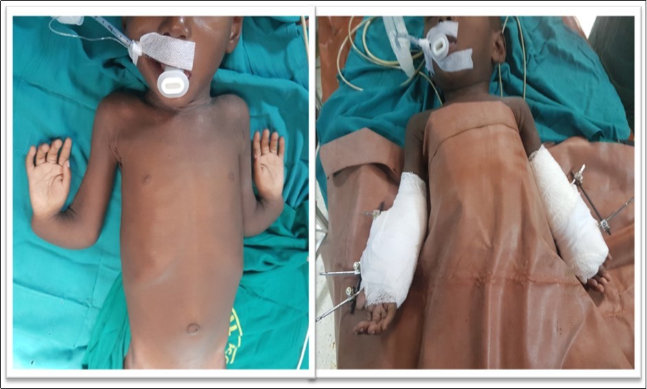 Immediate pre- and post-operative pictures with both forearms in supination