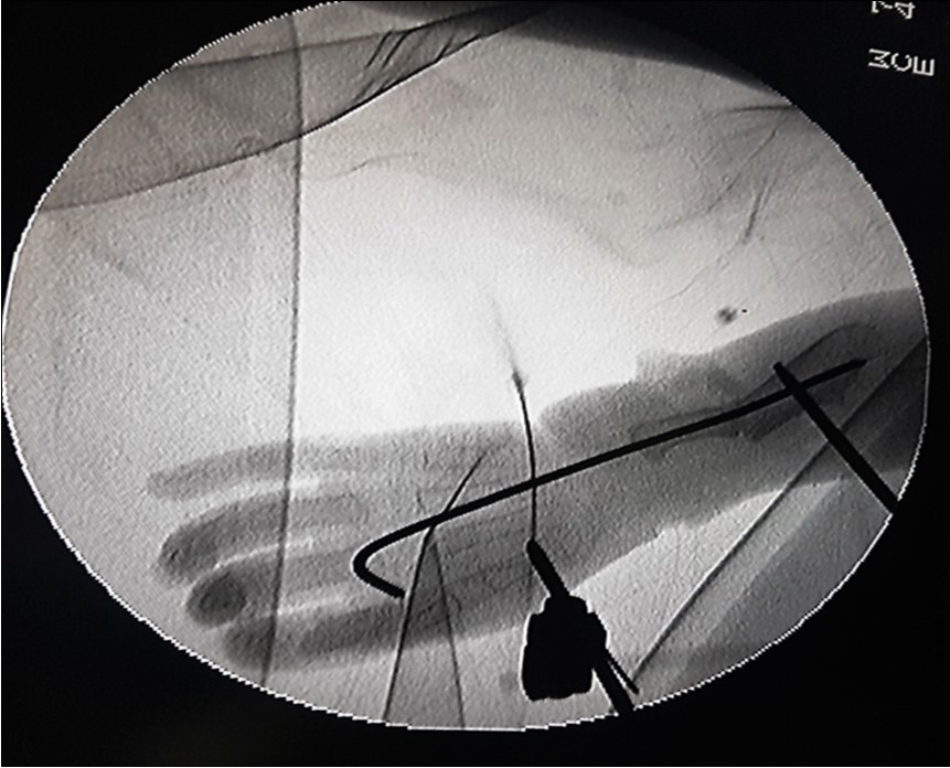 Fluoroscopic image showing the K-wire running from the 3rd metacarpal to bridge the ulnar osteotomy. The Schanze screws of the external fixator are shown, one each in the first metacarpal and in the proximal ulna with the forearm in pronation.