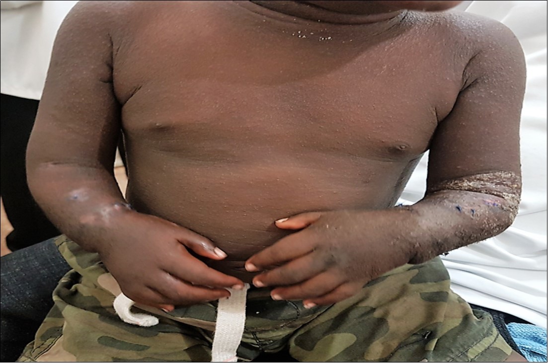 The appearance of the forearms at 12 weeks after removal of the external fixators