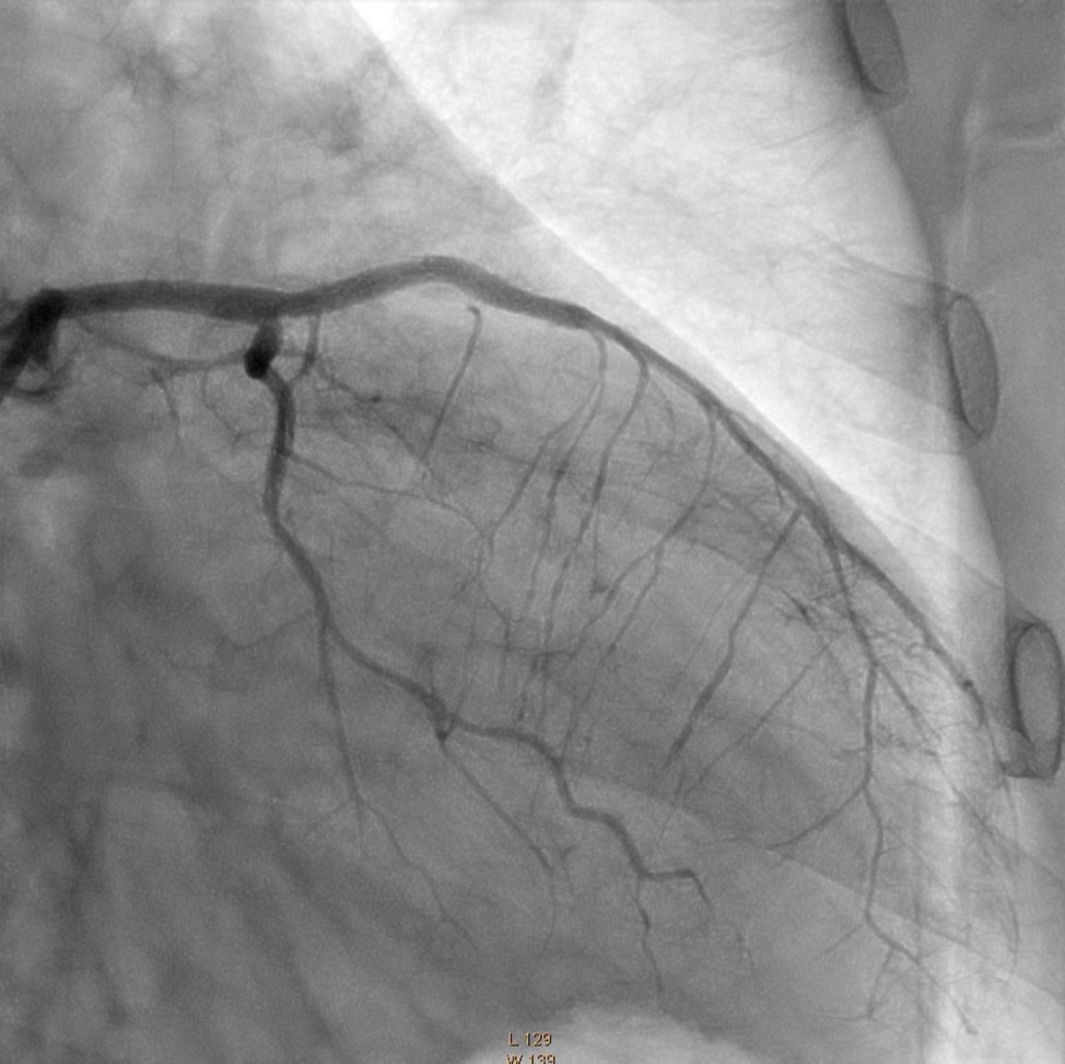 Left Coronary Artery, final result of the intervention.