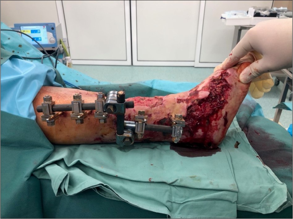 high energy injury