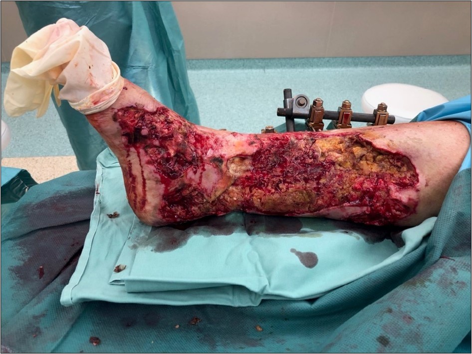 high energy injury