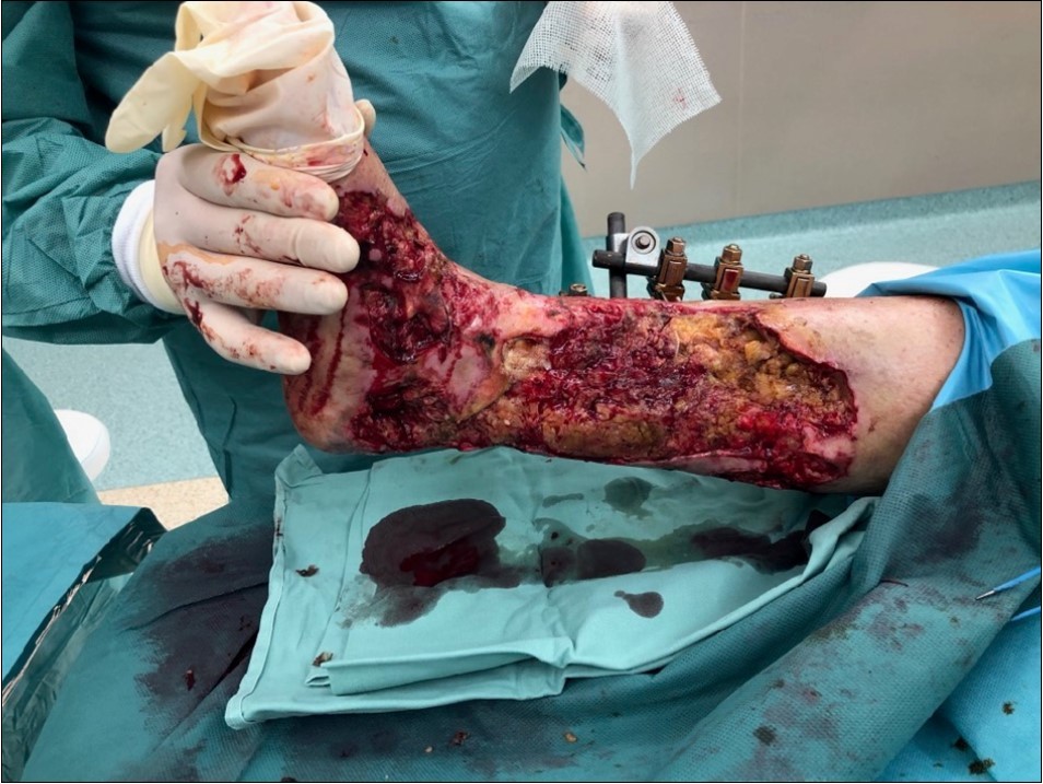 high energy injury