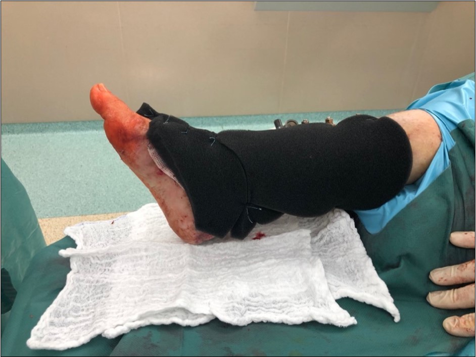 high energy injury