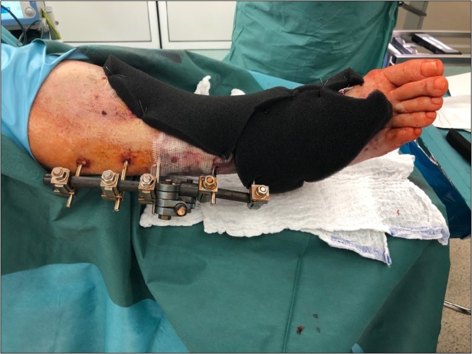 high energy injury