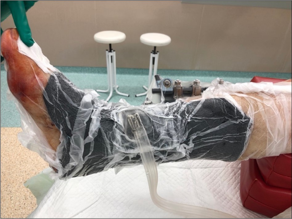high energy injury