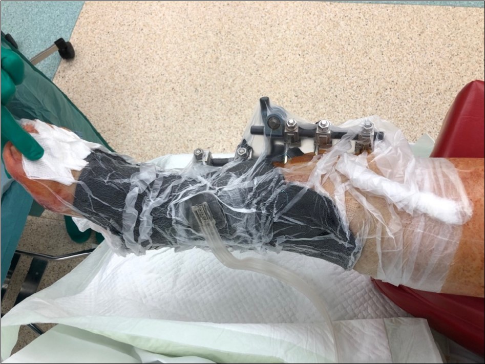 high energy injury