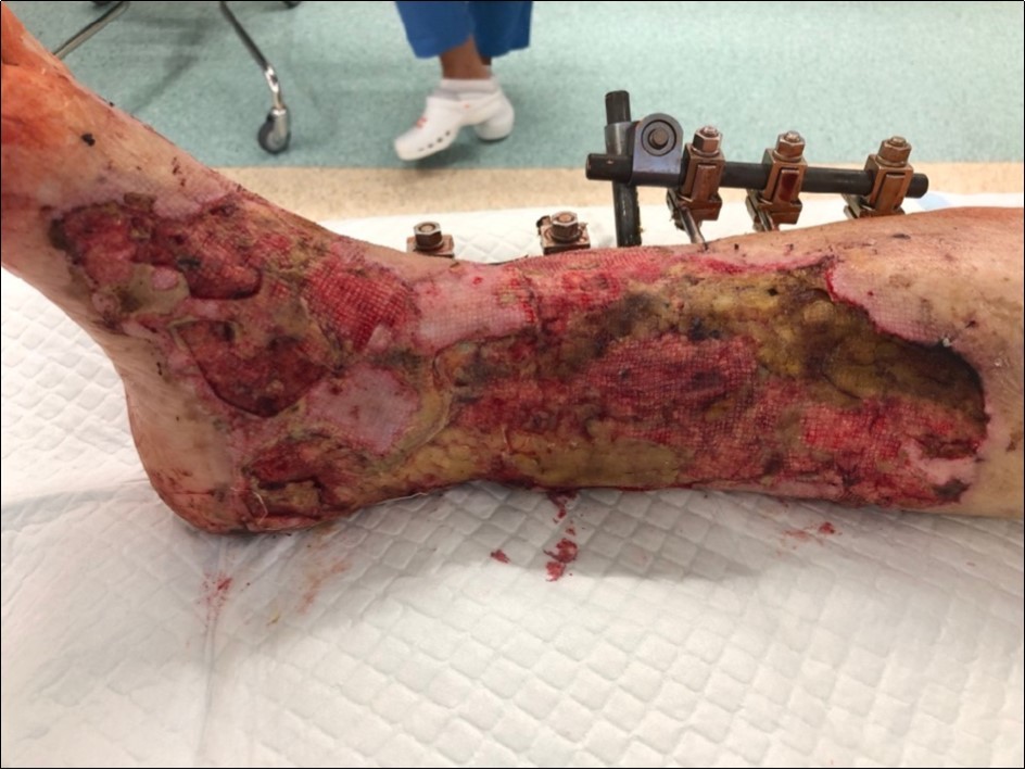 high energy injury