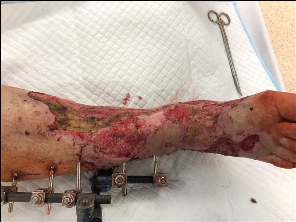 high energy injury