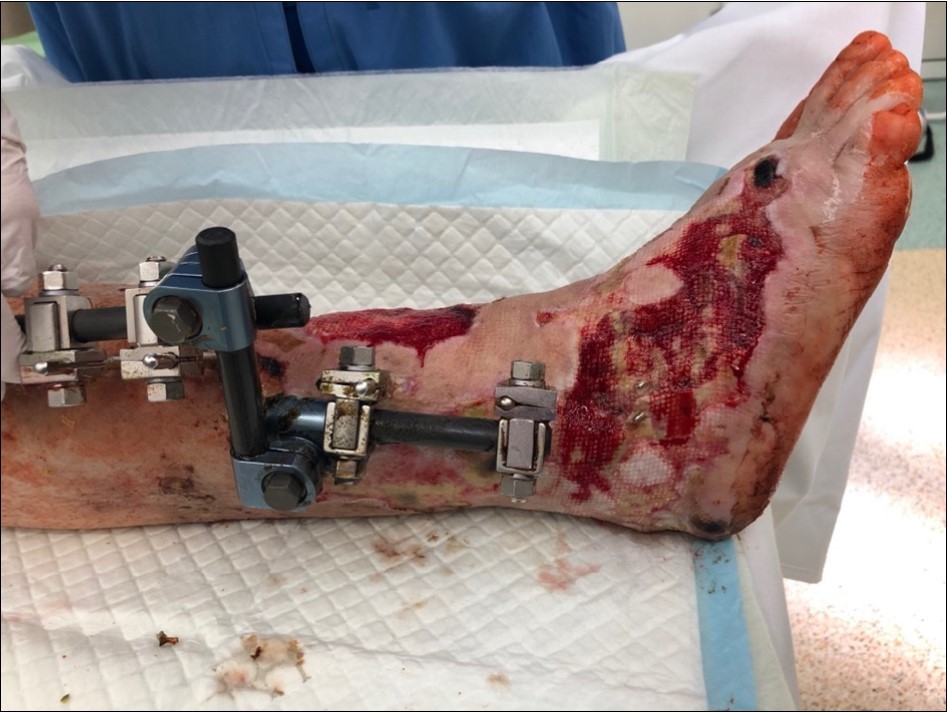 high energy injury
