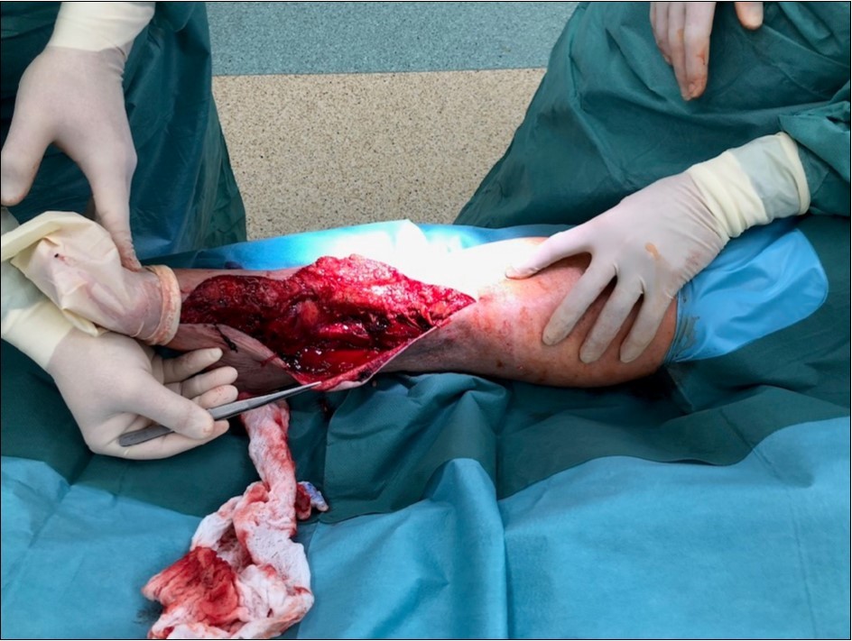 high energy injury