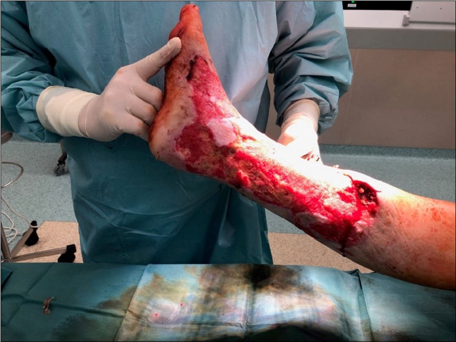 high energy injury