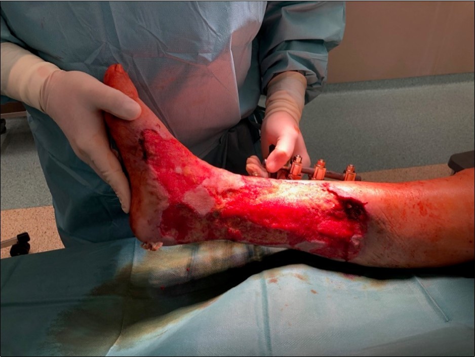 high energy injury