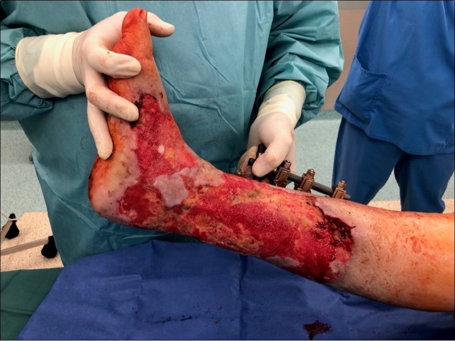 high energy injury