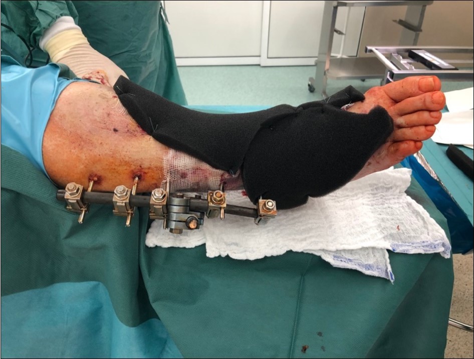 high energy injury