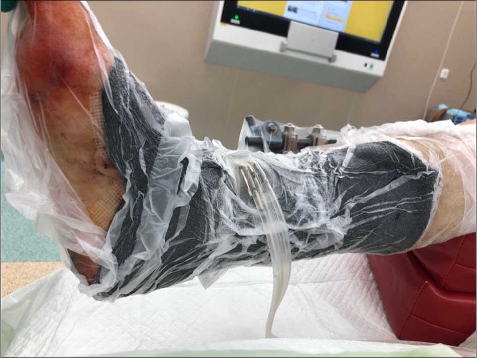 high energy injury