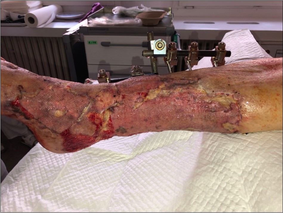 high energy injury