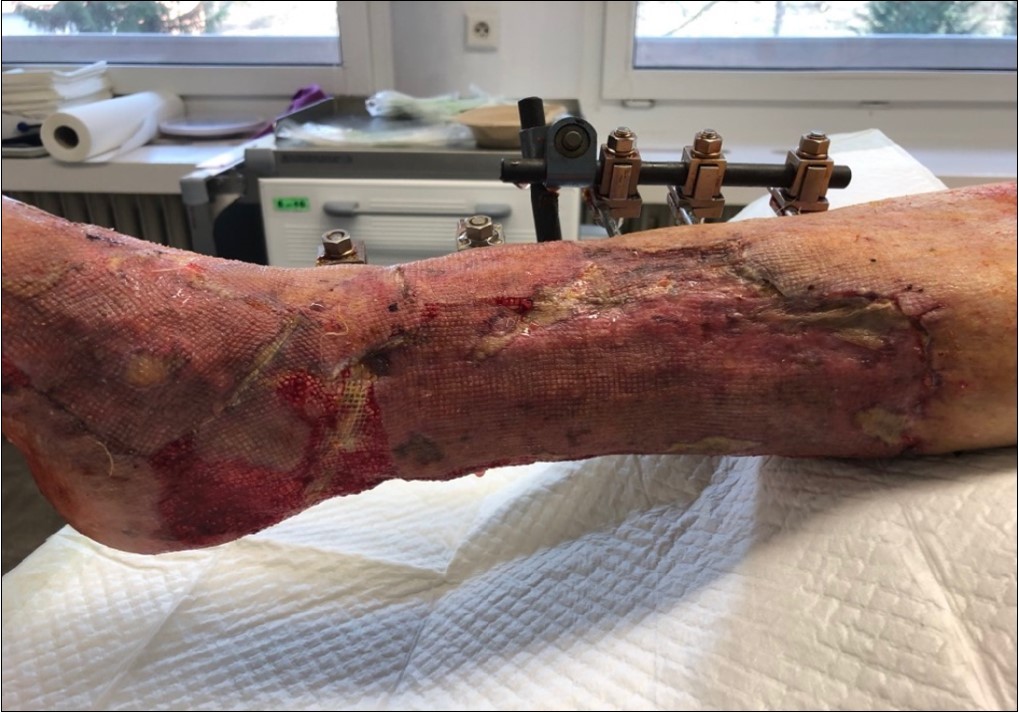 high energy injury