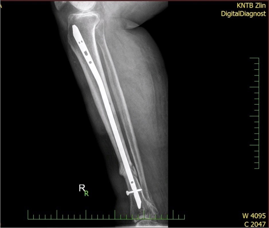 high energy injury