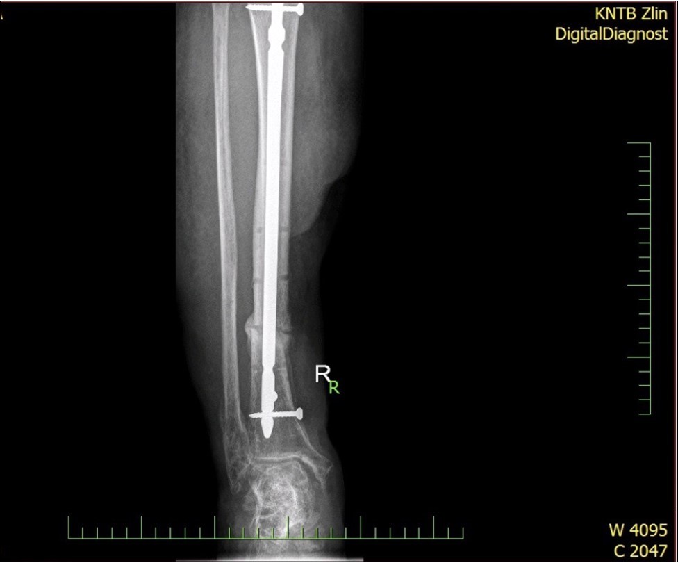 high energy injury