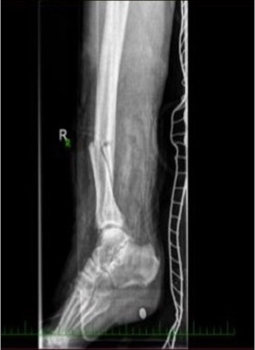high energy injury