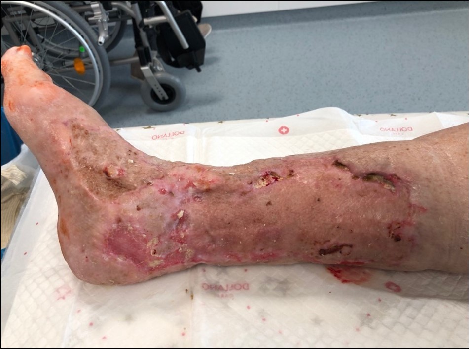 high energy injury