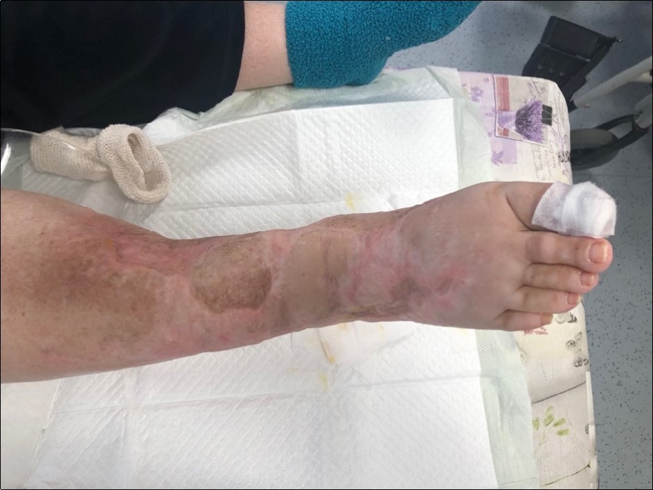 high energy injury