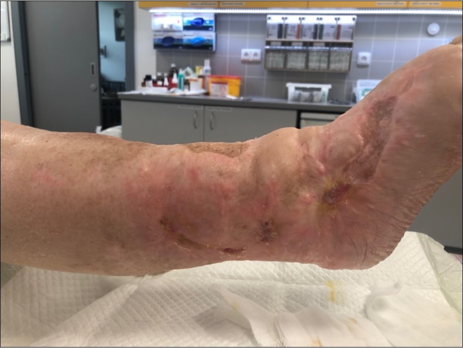 high energy injury
