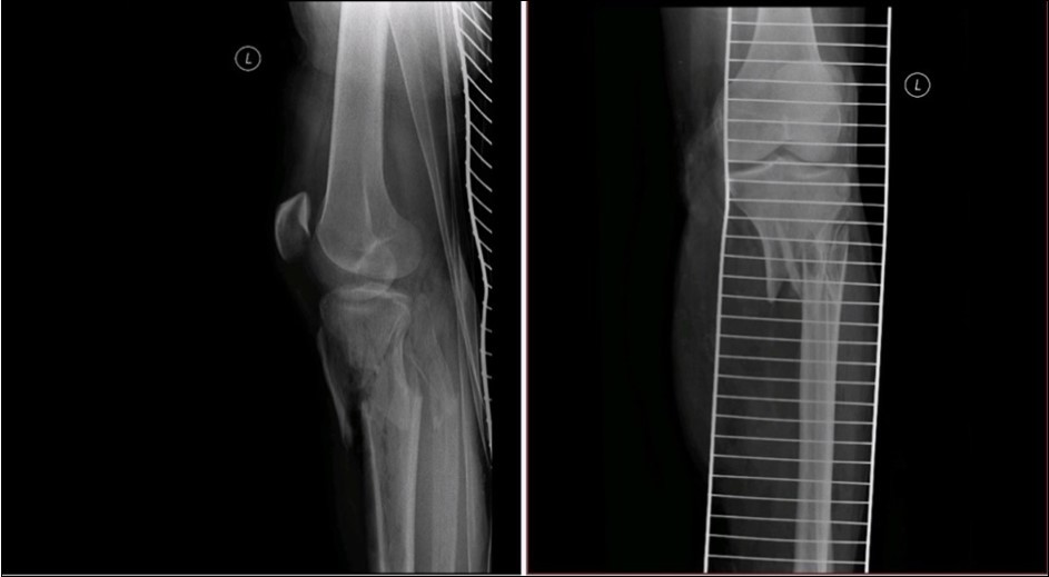 high energy injury