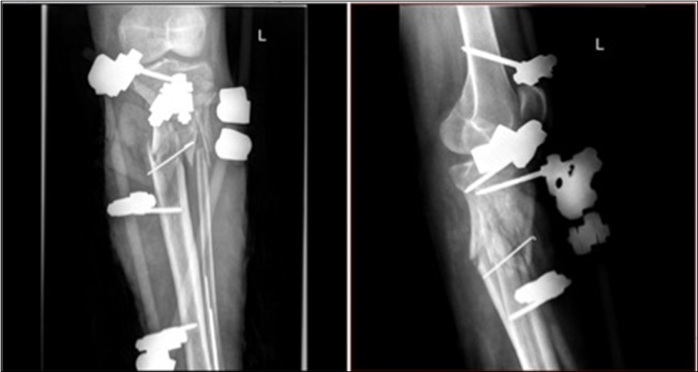 high energy injury