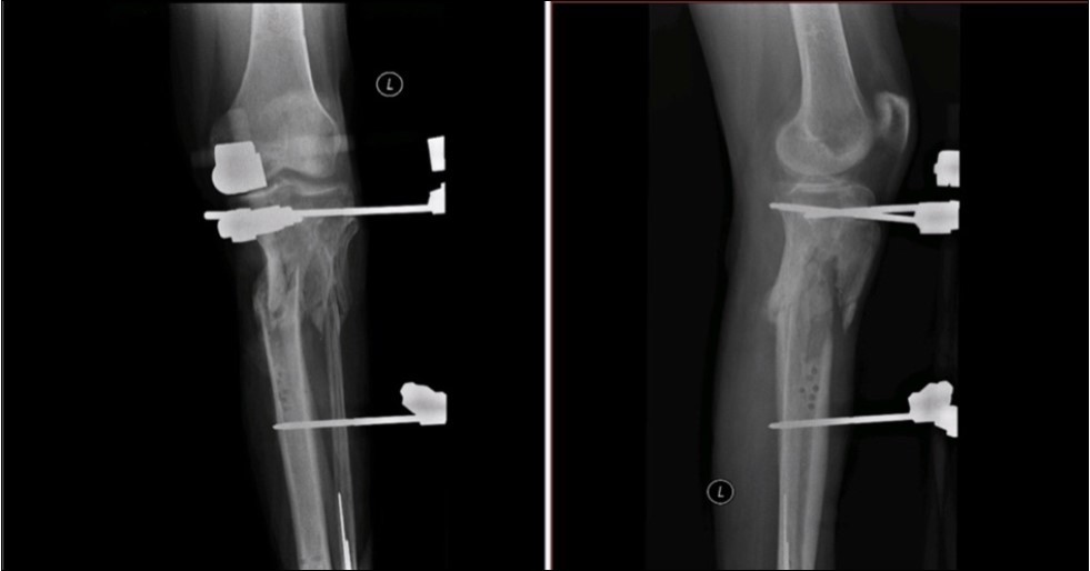 high energy injury