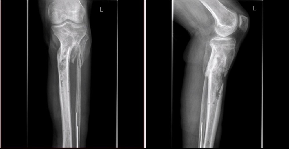 high energy injury