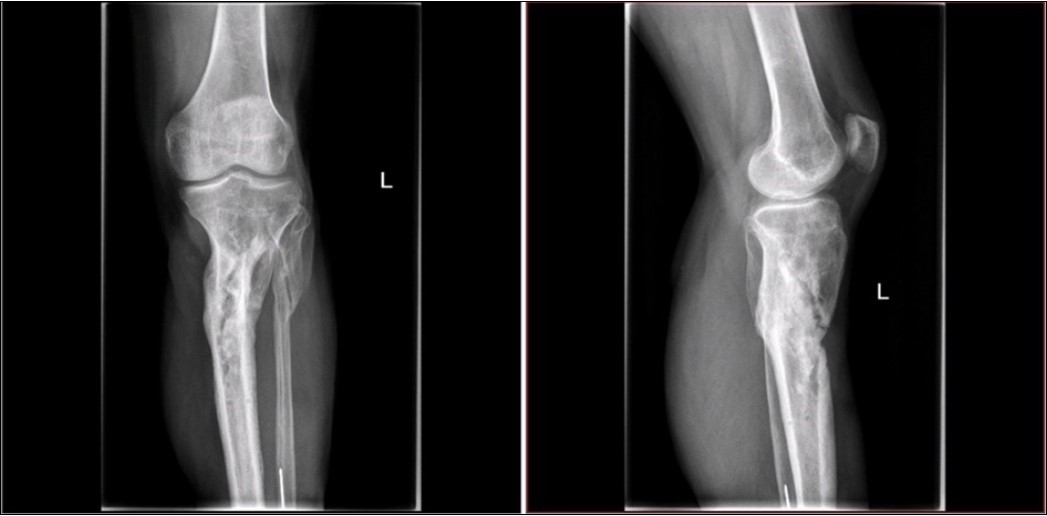 high energy injury