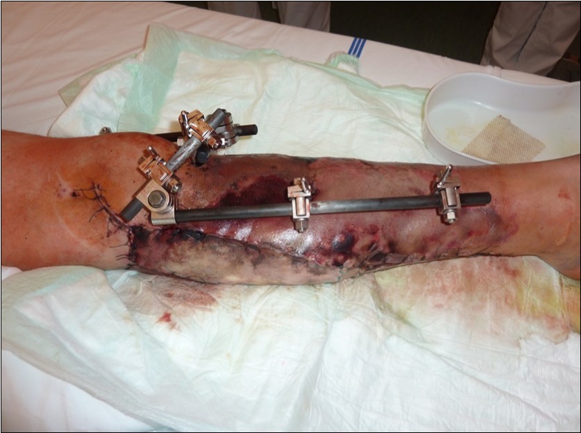 high energy injury