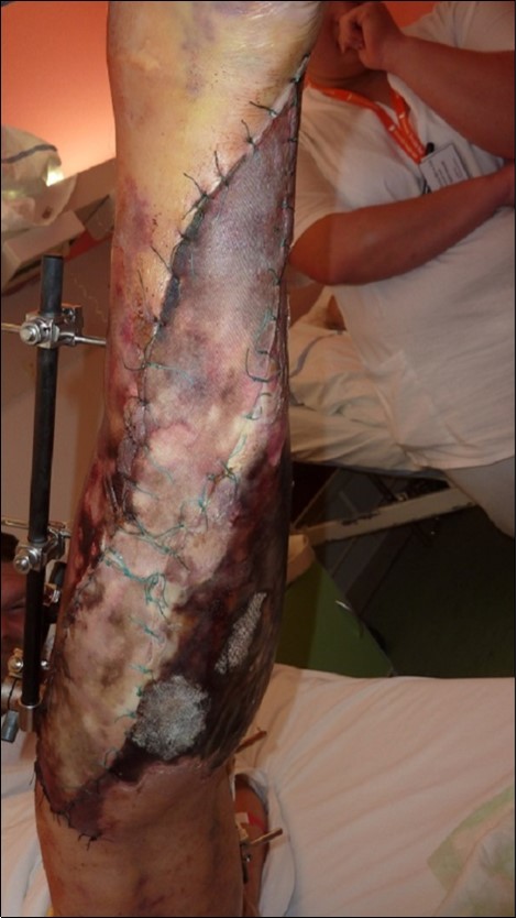 high energy injury